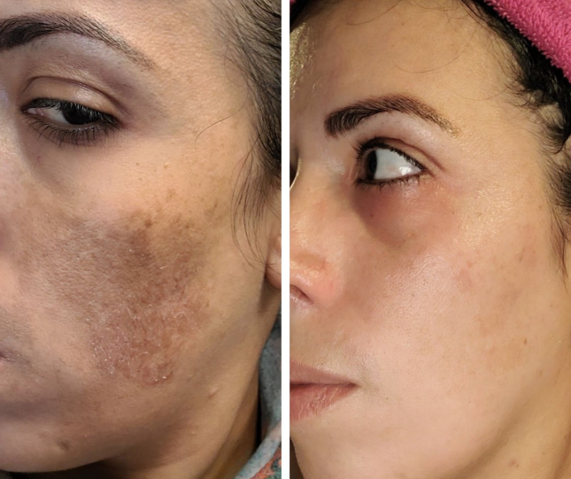 21-day pigment clearance